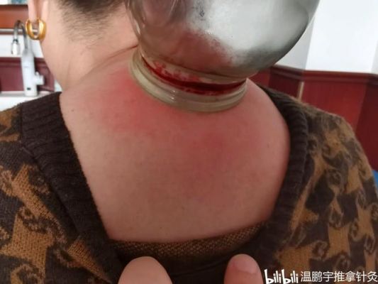 神医放血治疗通关攻略